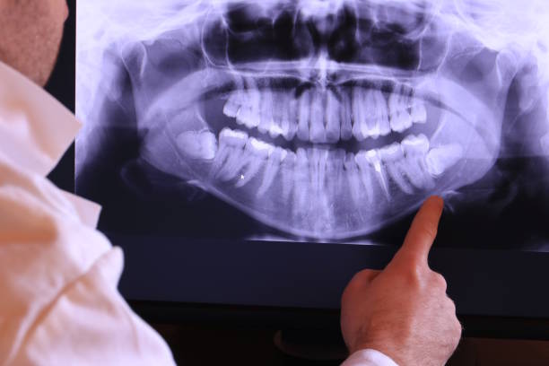 Best Emergency Dental Care for Broken or Chipped Teeth in Hemlock, MI